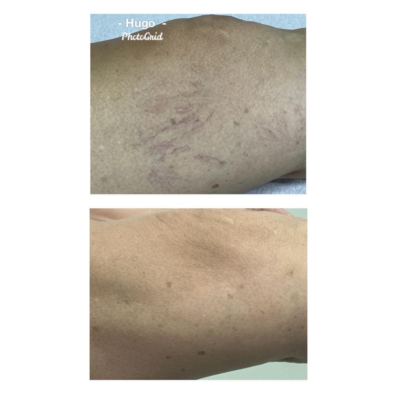 Resultado de tratamento vascular 4