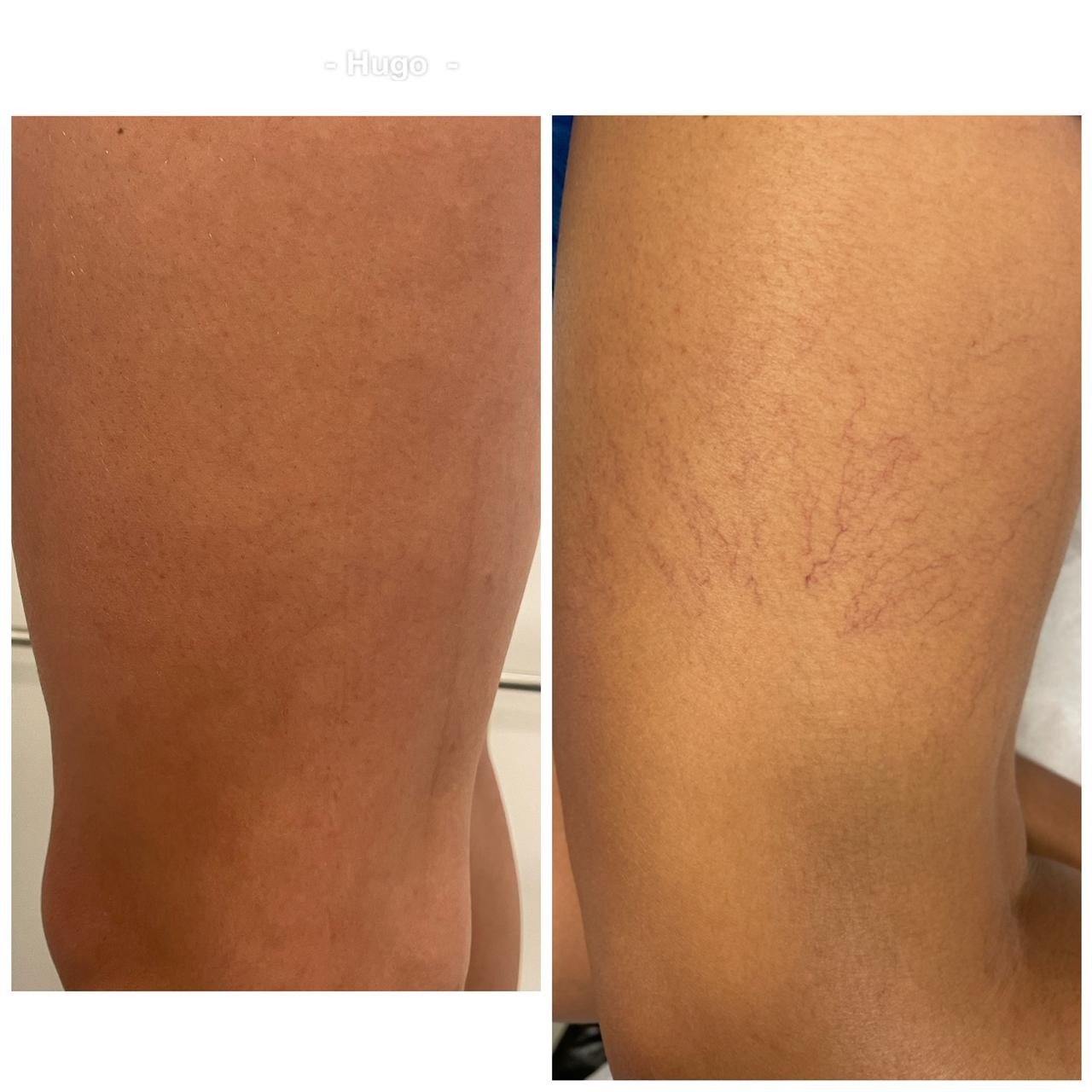 Resultado de tratamento vascular 6